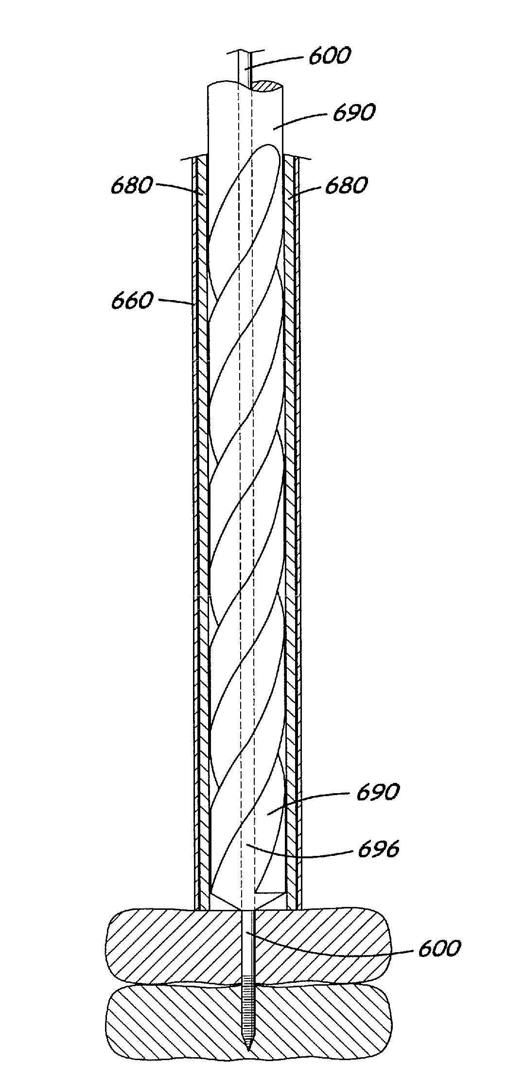 Tack for spine fixation