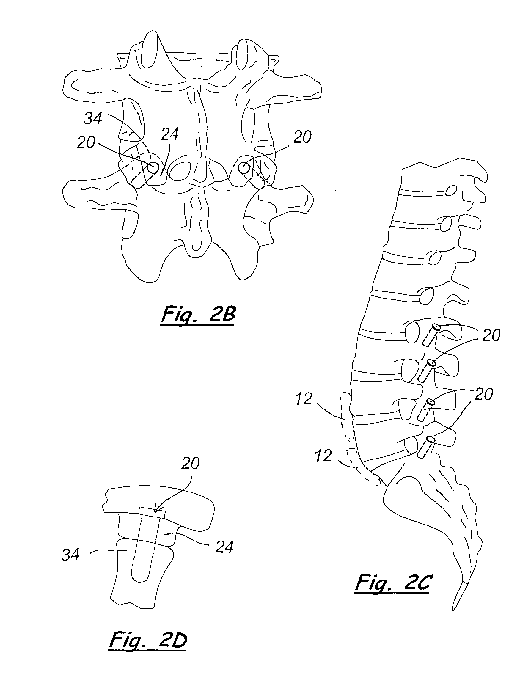 Tack for spine fixation