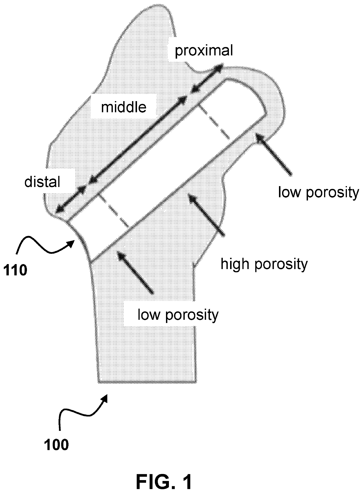 Customized load-bearing and bioactive functionally-graded implant for treatment of osteonecrosis