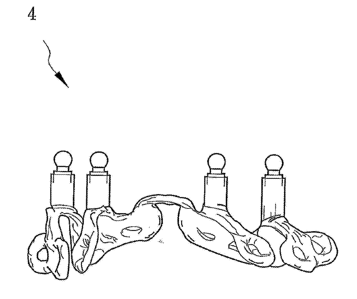 Tooth implantation technique and a subperiosteal implant manufacturing method for the solution of extreme atrophy of a tooth bone