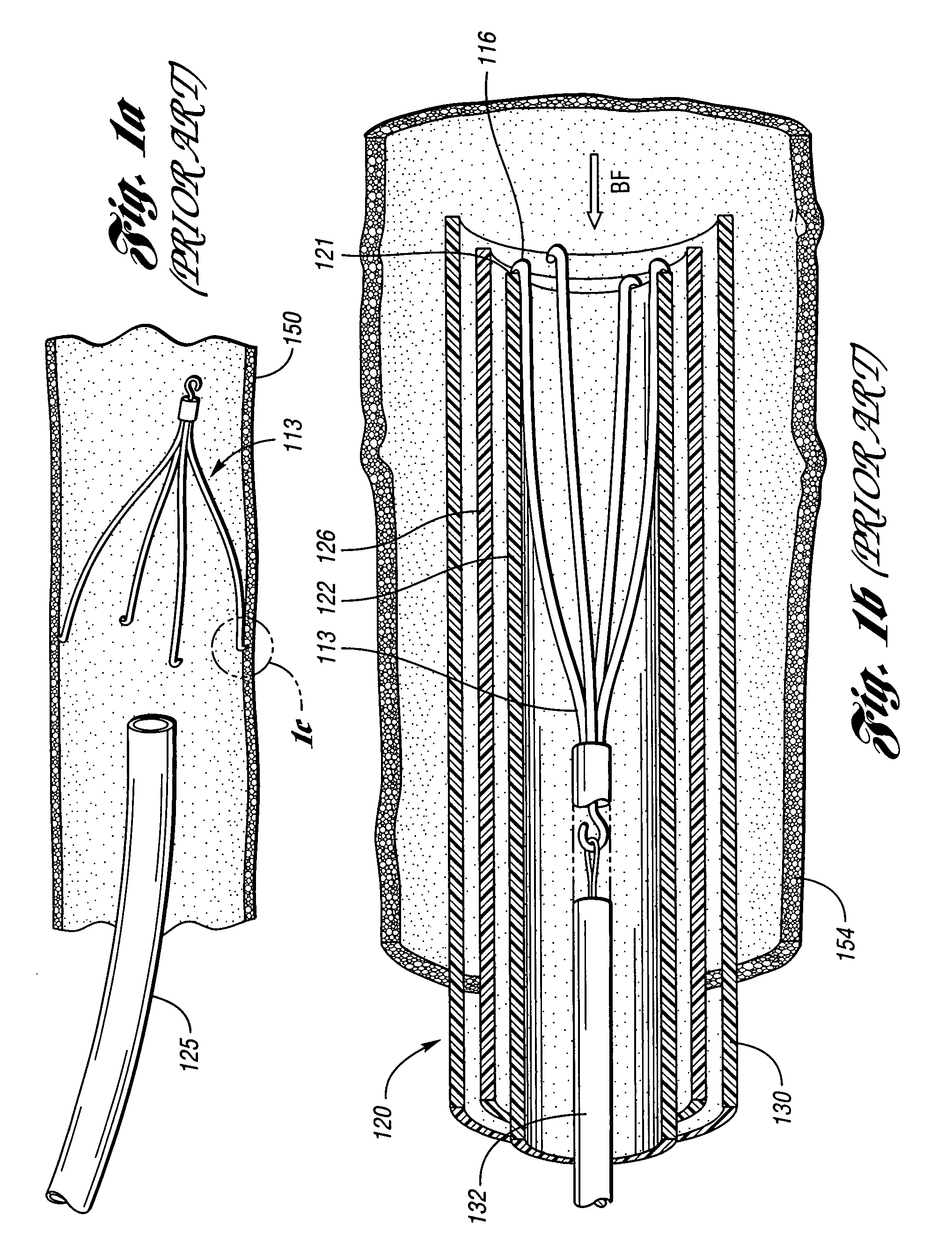 Removable vena cava filter with anchoring feature for reduced trauma