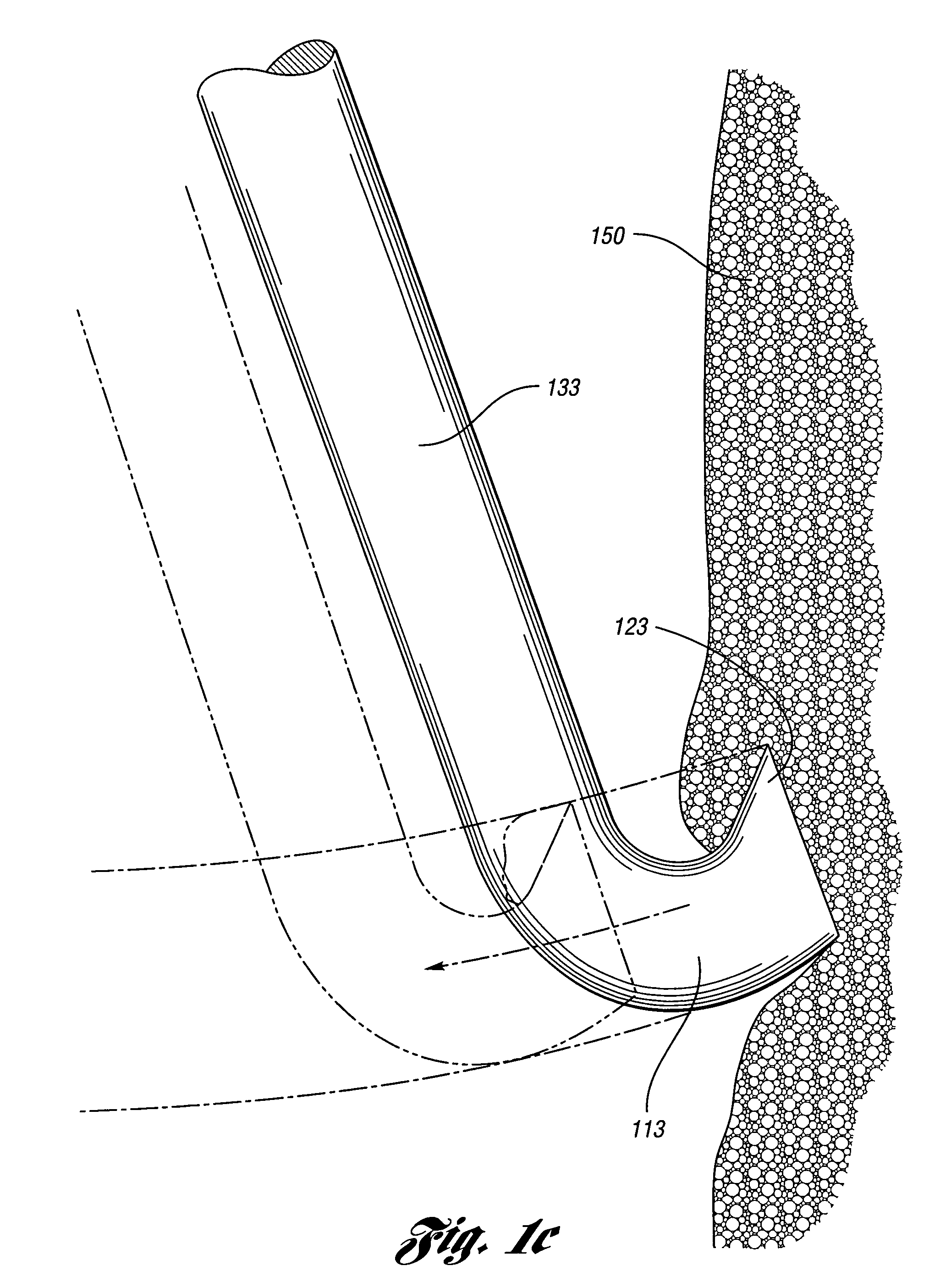 Removable vena cava filter with anchoring feature for reduced trauma