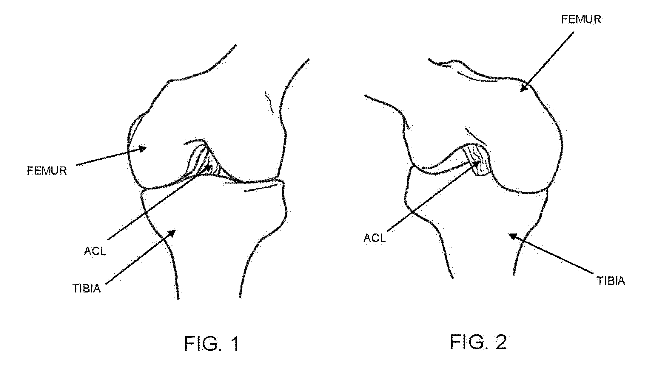 Method and apparatus for reconstructing a ligament