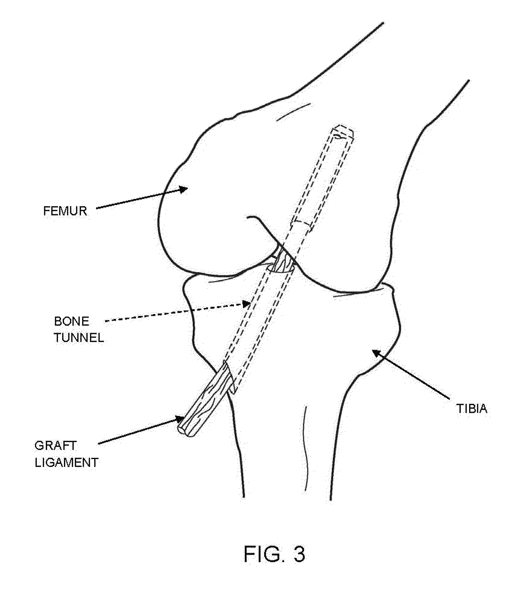 Method and apparatus for reconstructing a ligament