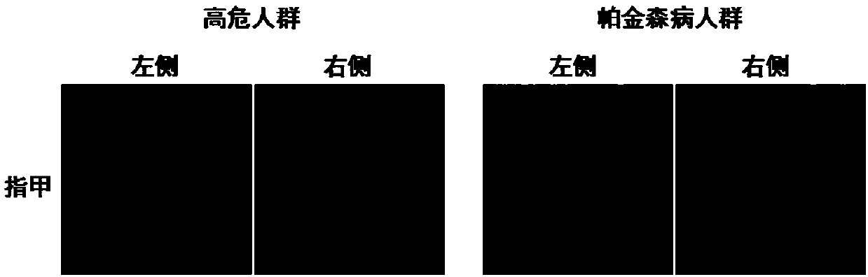 Method for judging occurrence of Parkinson's diseases based on spontaneous fluorescence on fingernails and application thereof