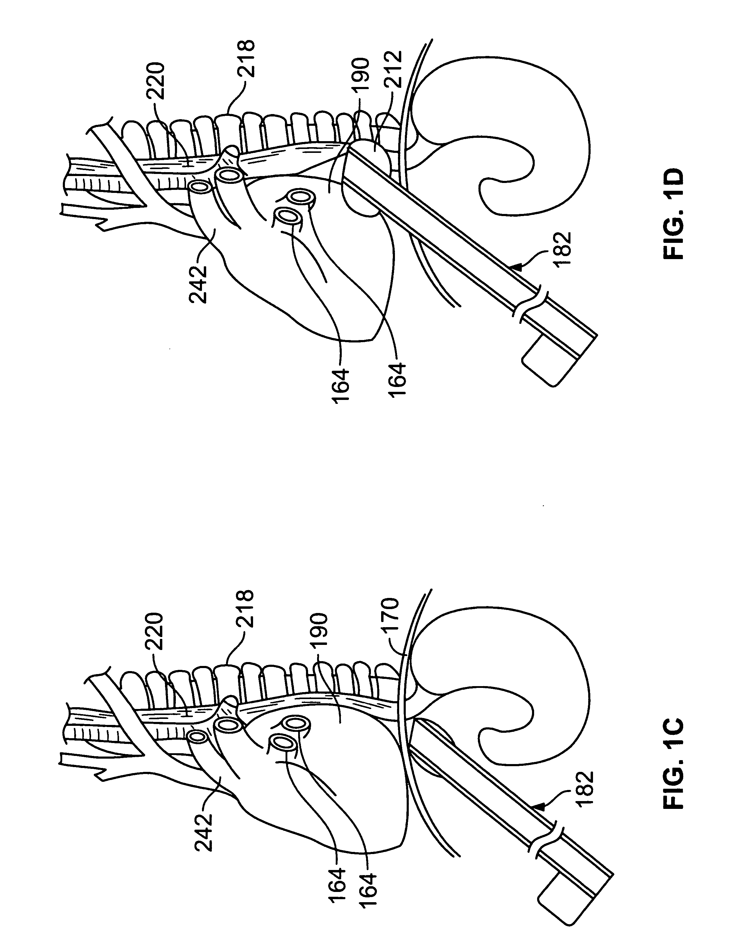 Diaphragm entry for posterior surgical access