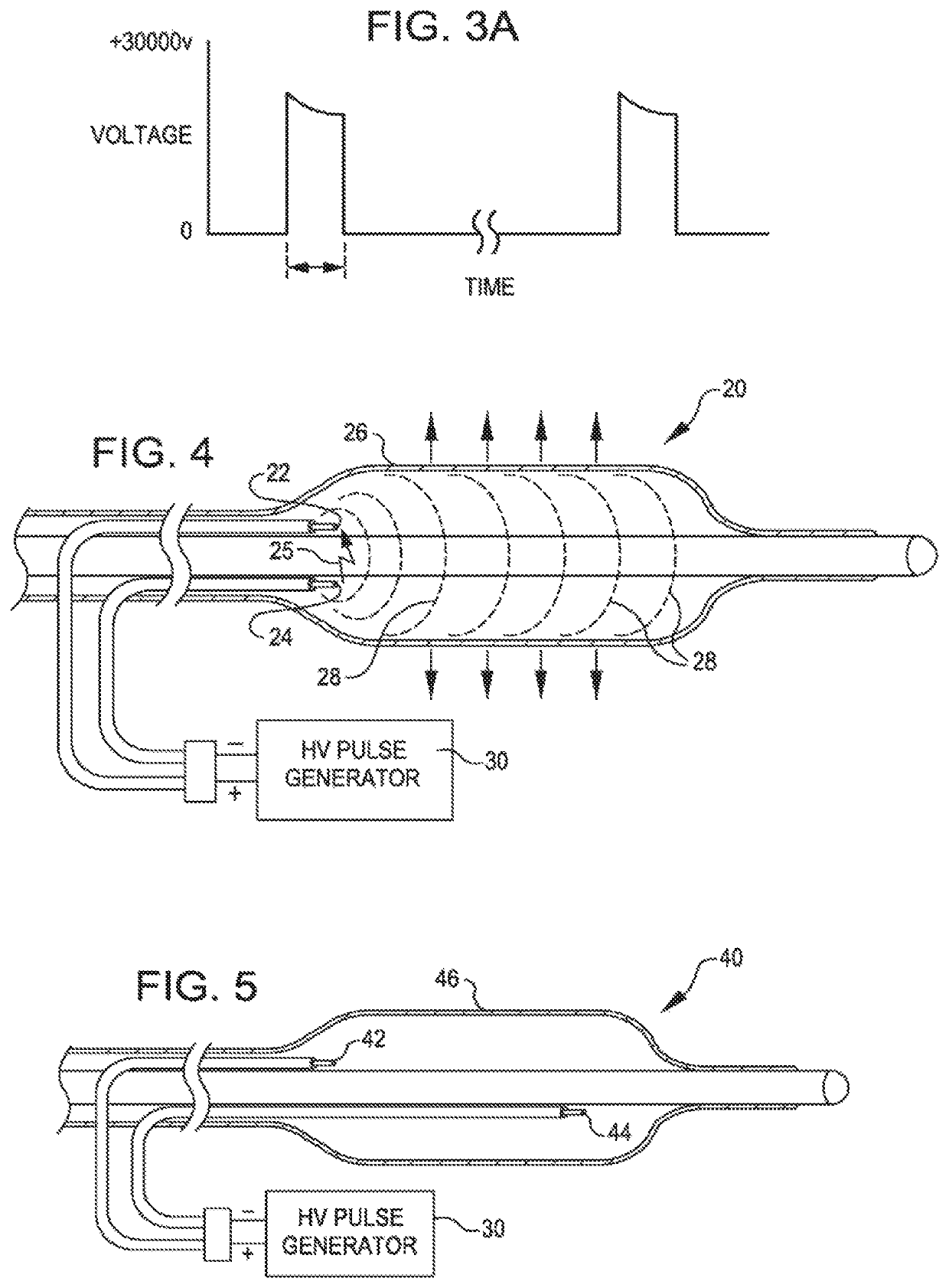 Two-stage method for treating calcified lesions within the wall of a blood vessel