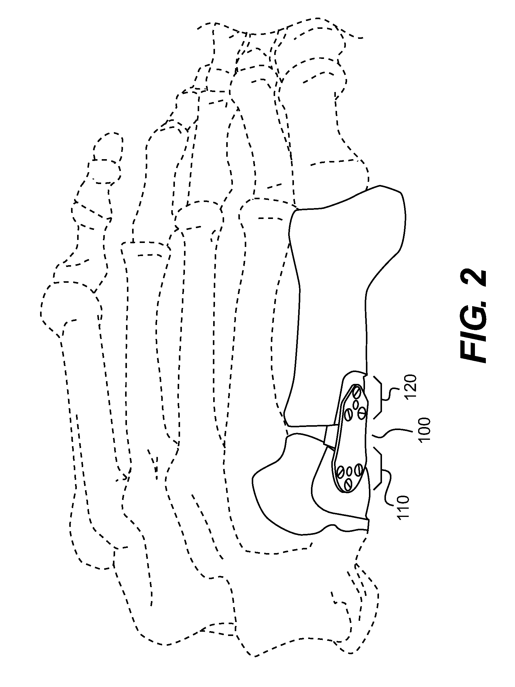 Implant for correcting skeletal mechanics