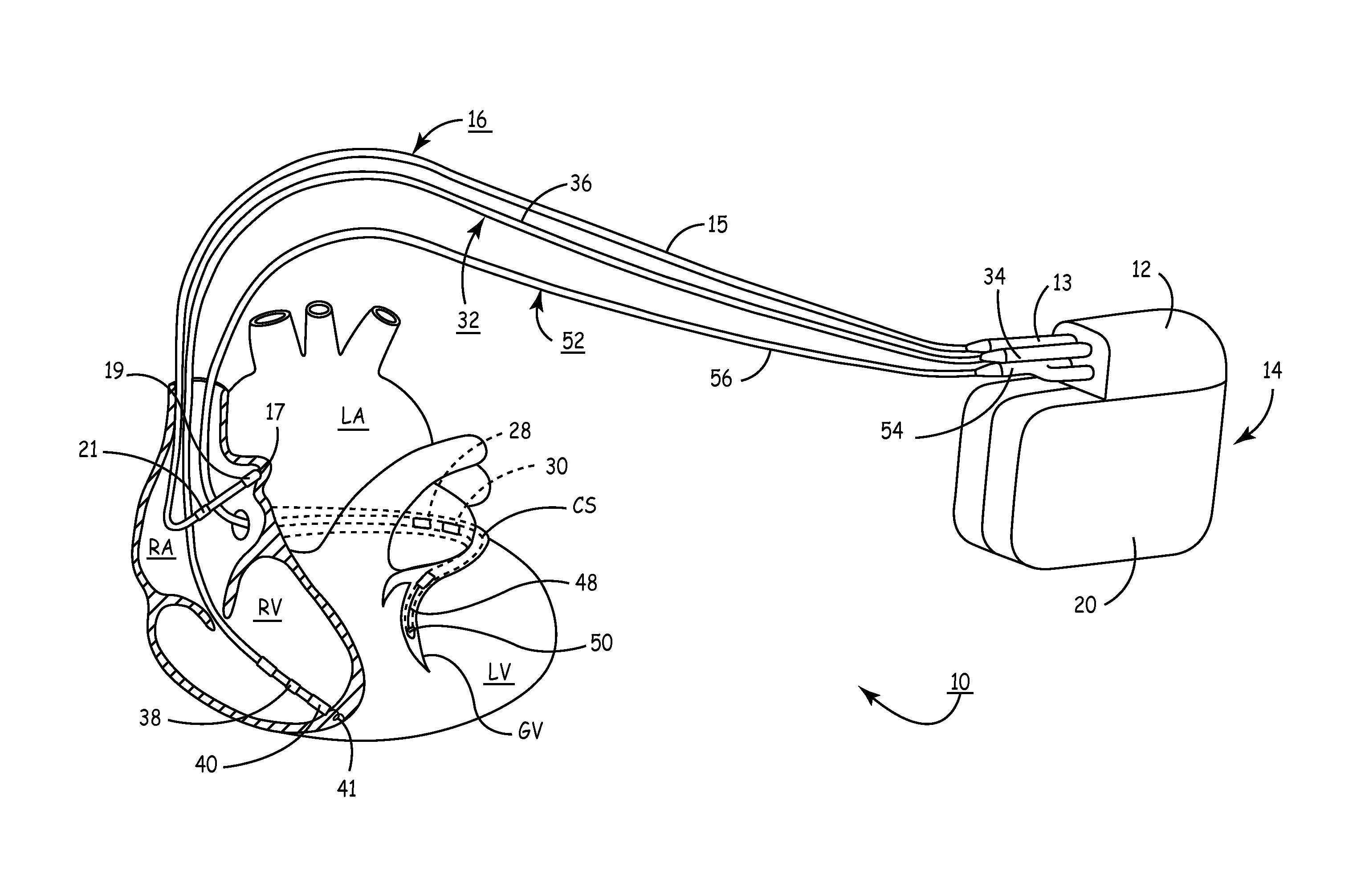 Apparatus and methods of optimizing atrioventricular pacing delay intervals