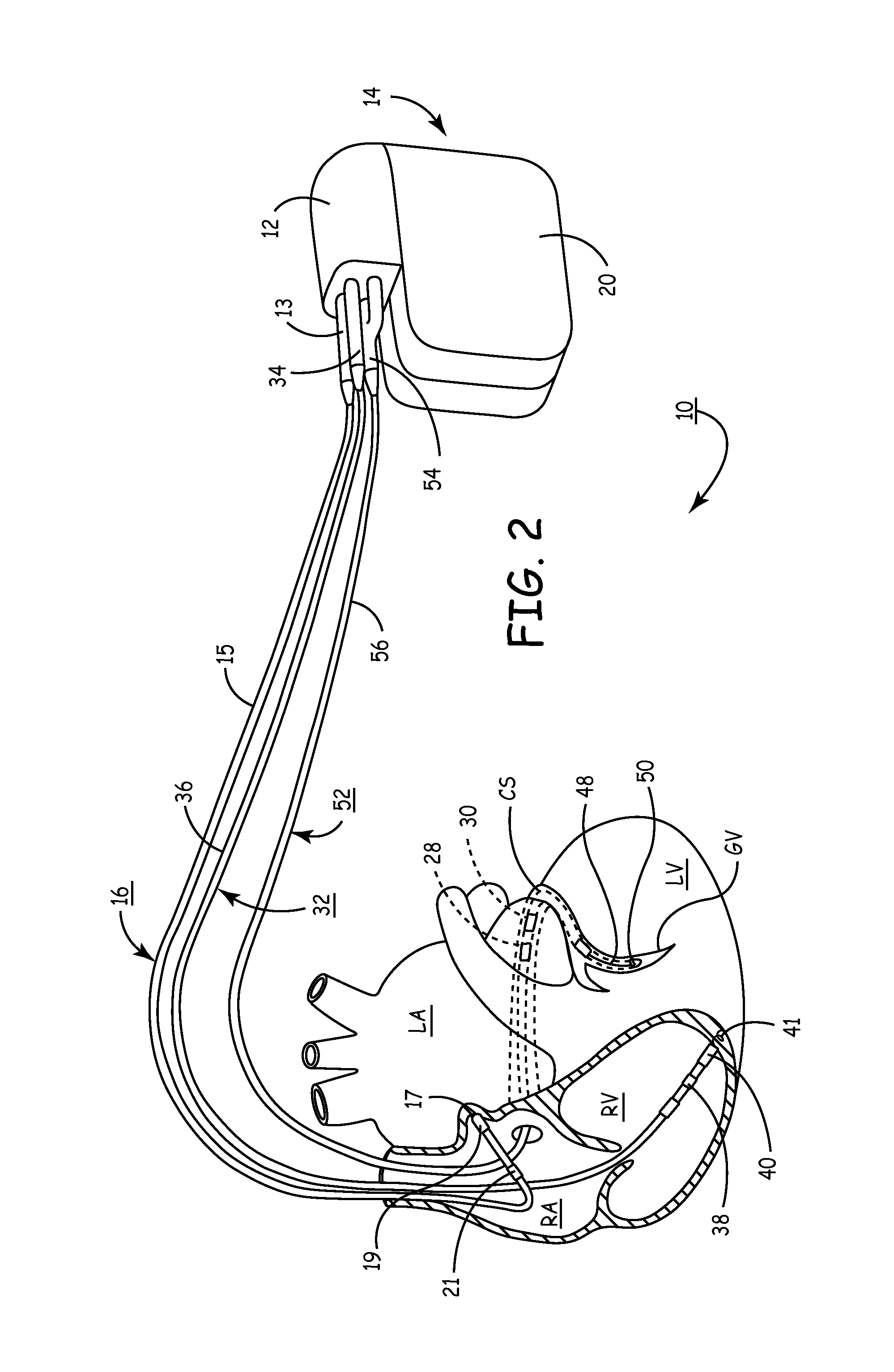 Apparatus and methods of optimizing atrioventricular pacing delay intervals