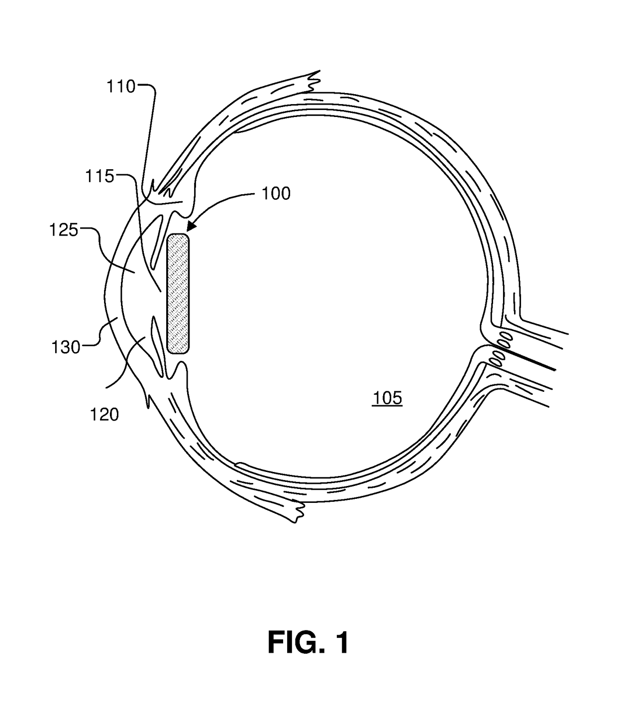 Accommodating intraocular lens with meniscus