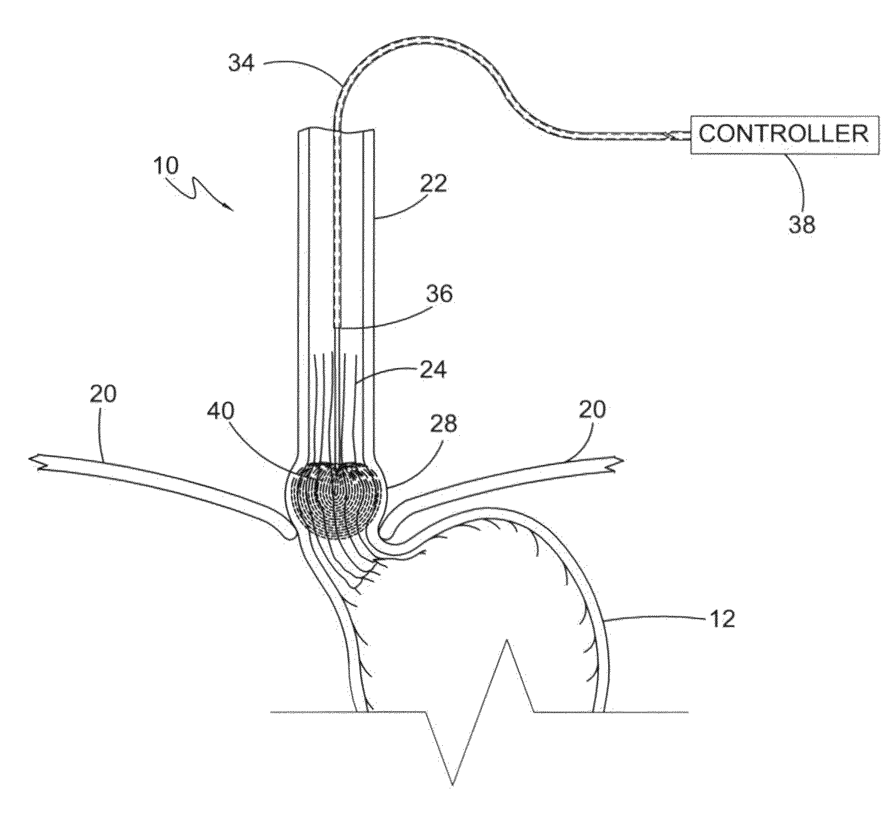 Irreversible electroporation (IRE) for esophageal disease