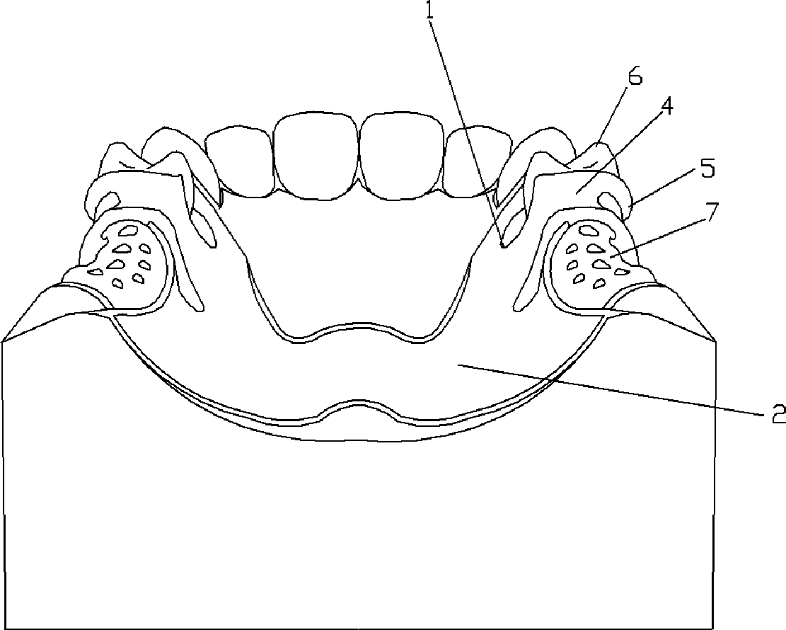 Plate rod snap ring for removable partial denture