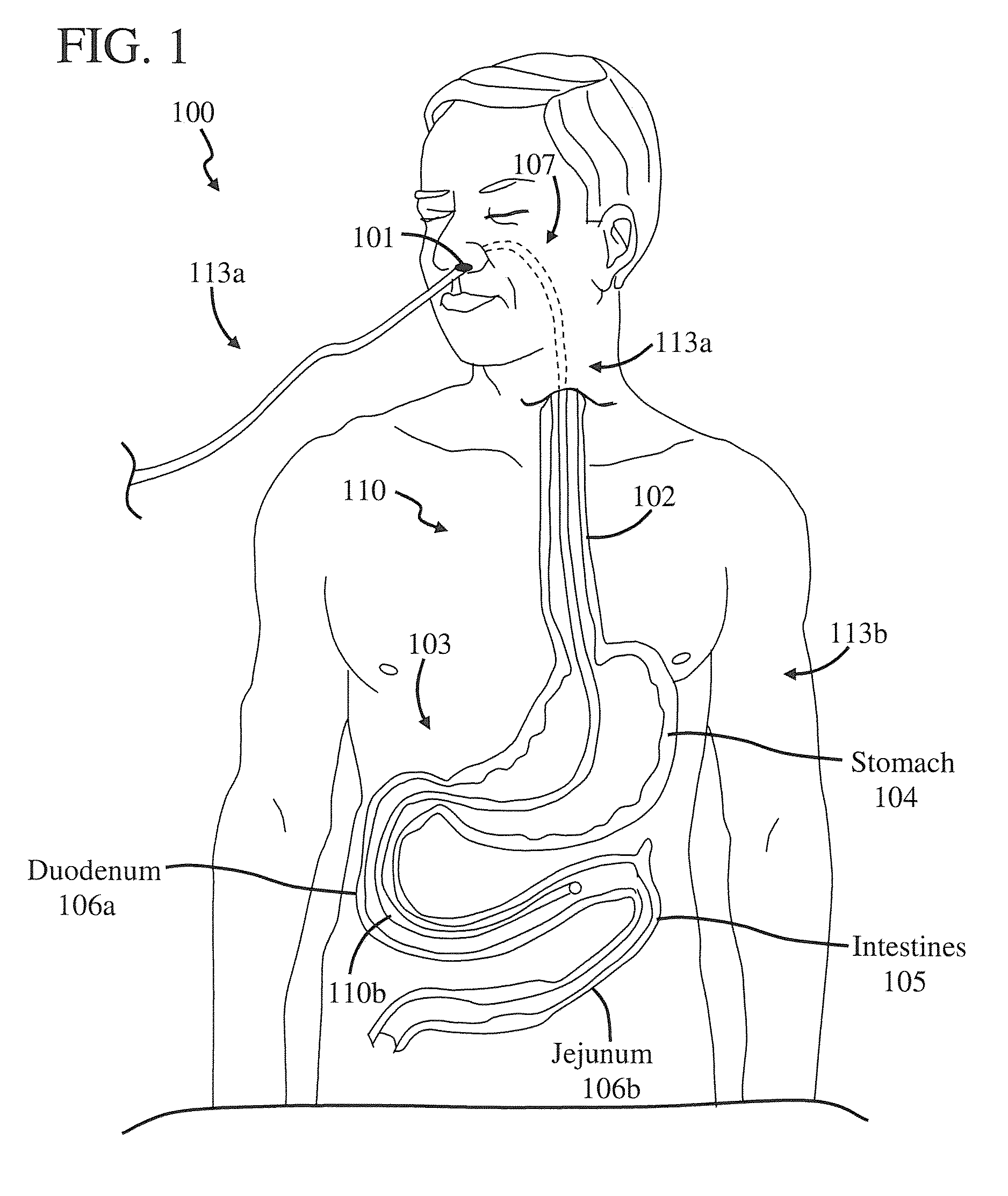 Catheter and method of making the same