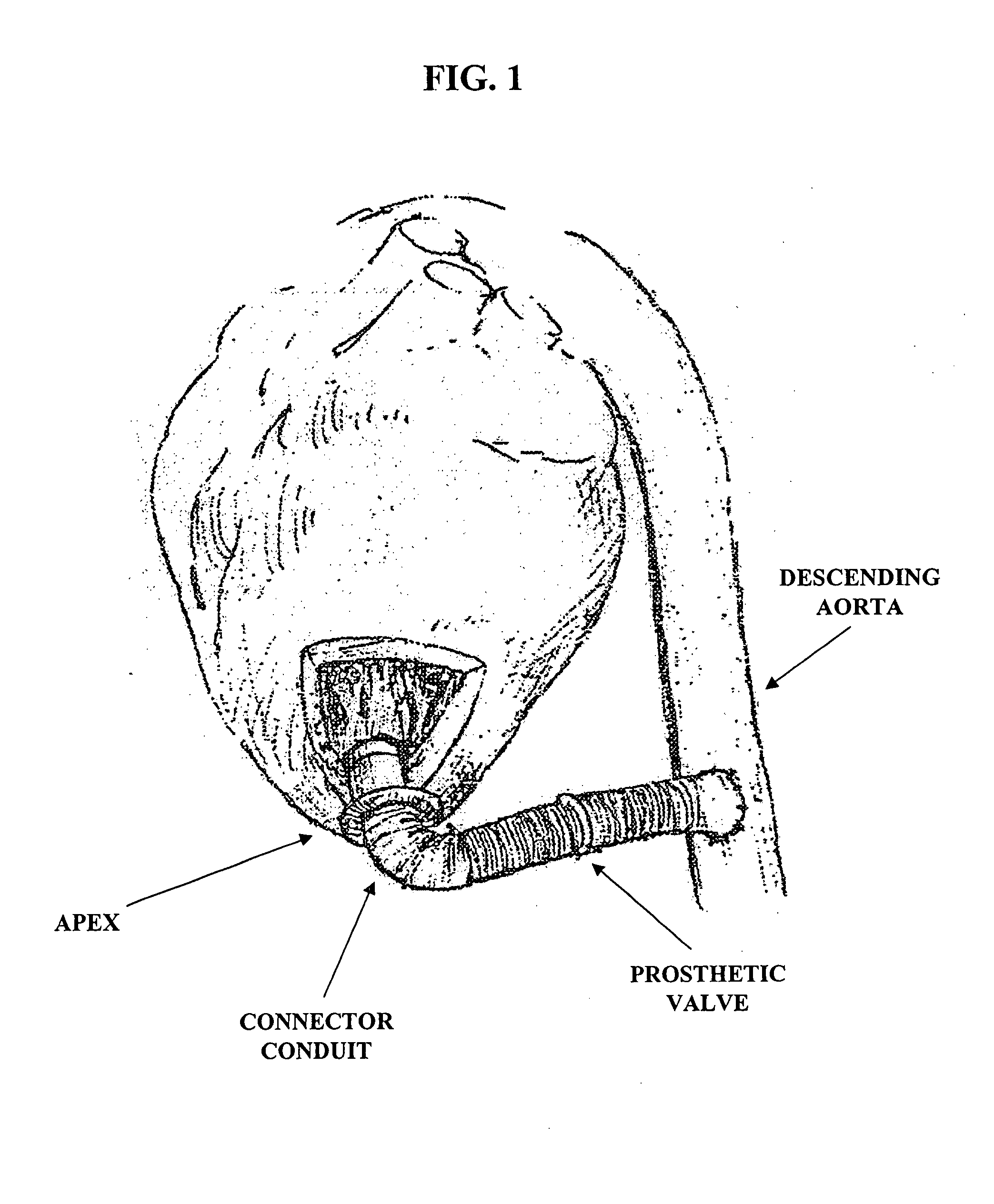 Apparatus and method for connecting a conduit to a hollow organ