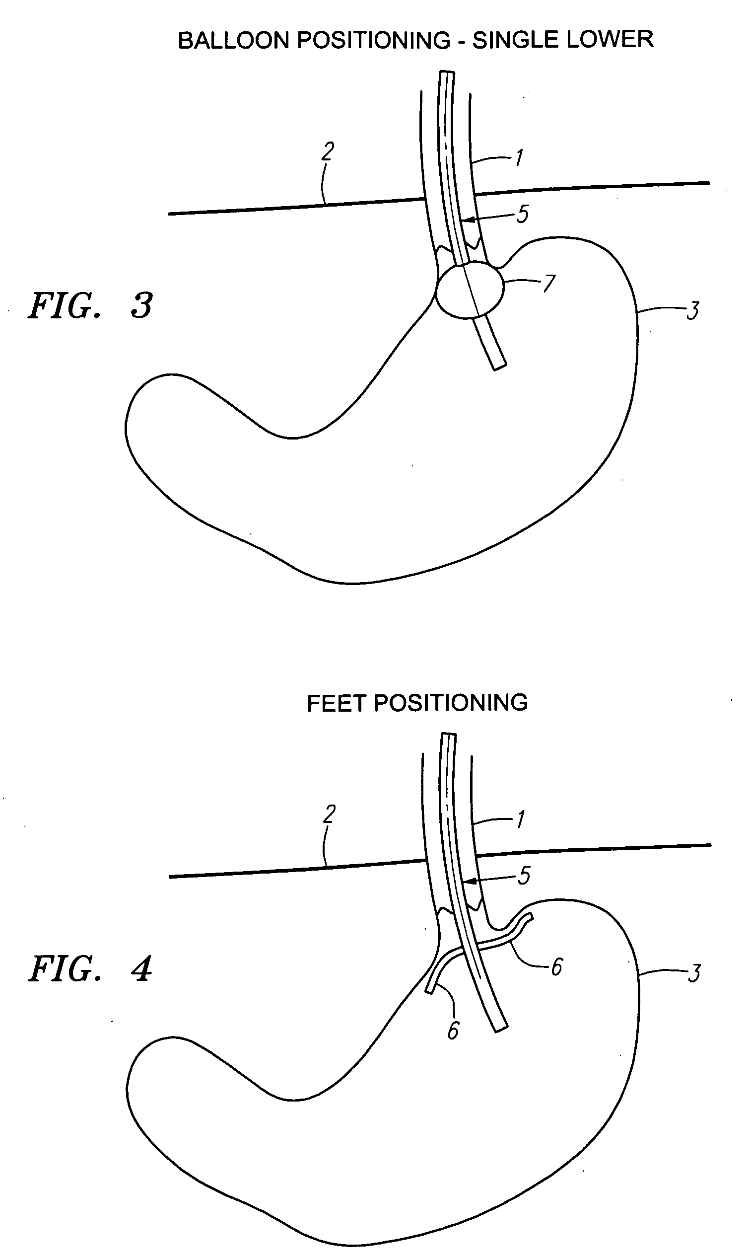 Methods and apparatus for treatment of obesity with an ultrasound device movable in two or three axes