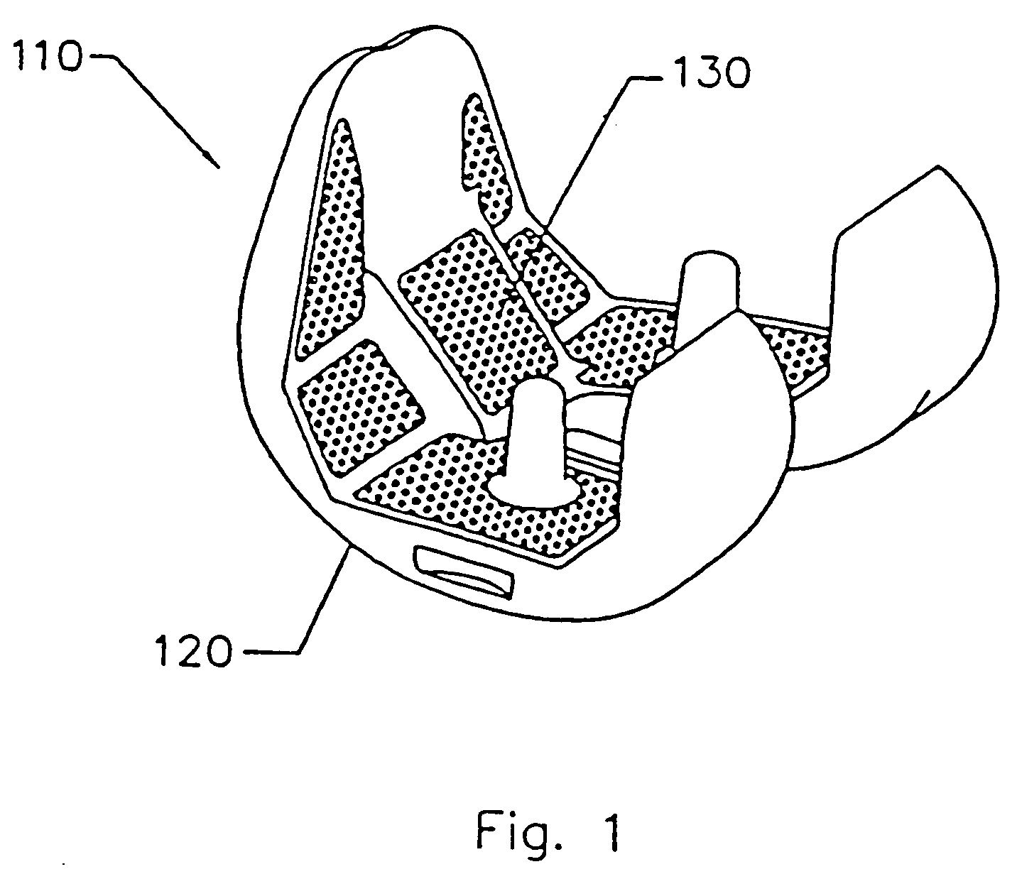 Implant with composite coating