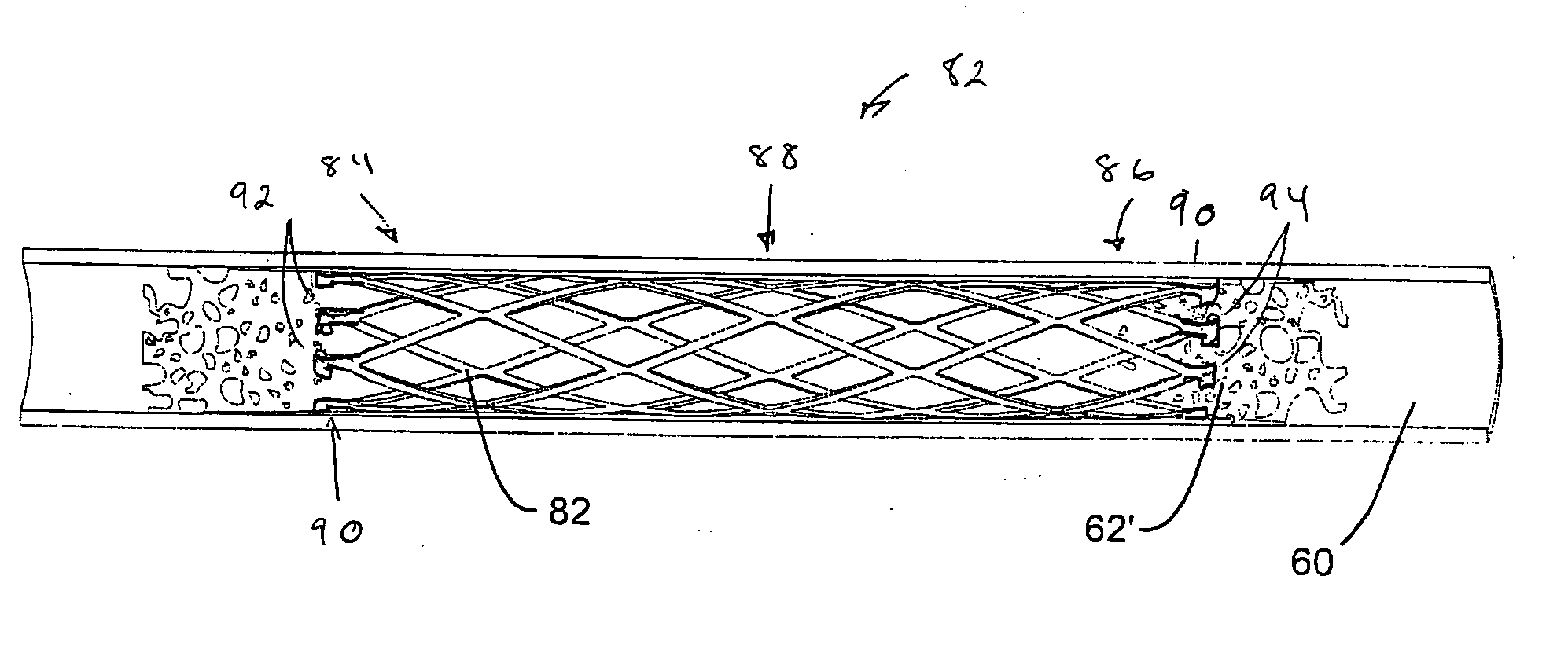 Pass-through restraint electrolytic implant delivery systems