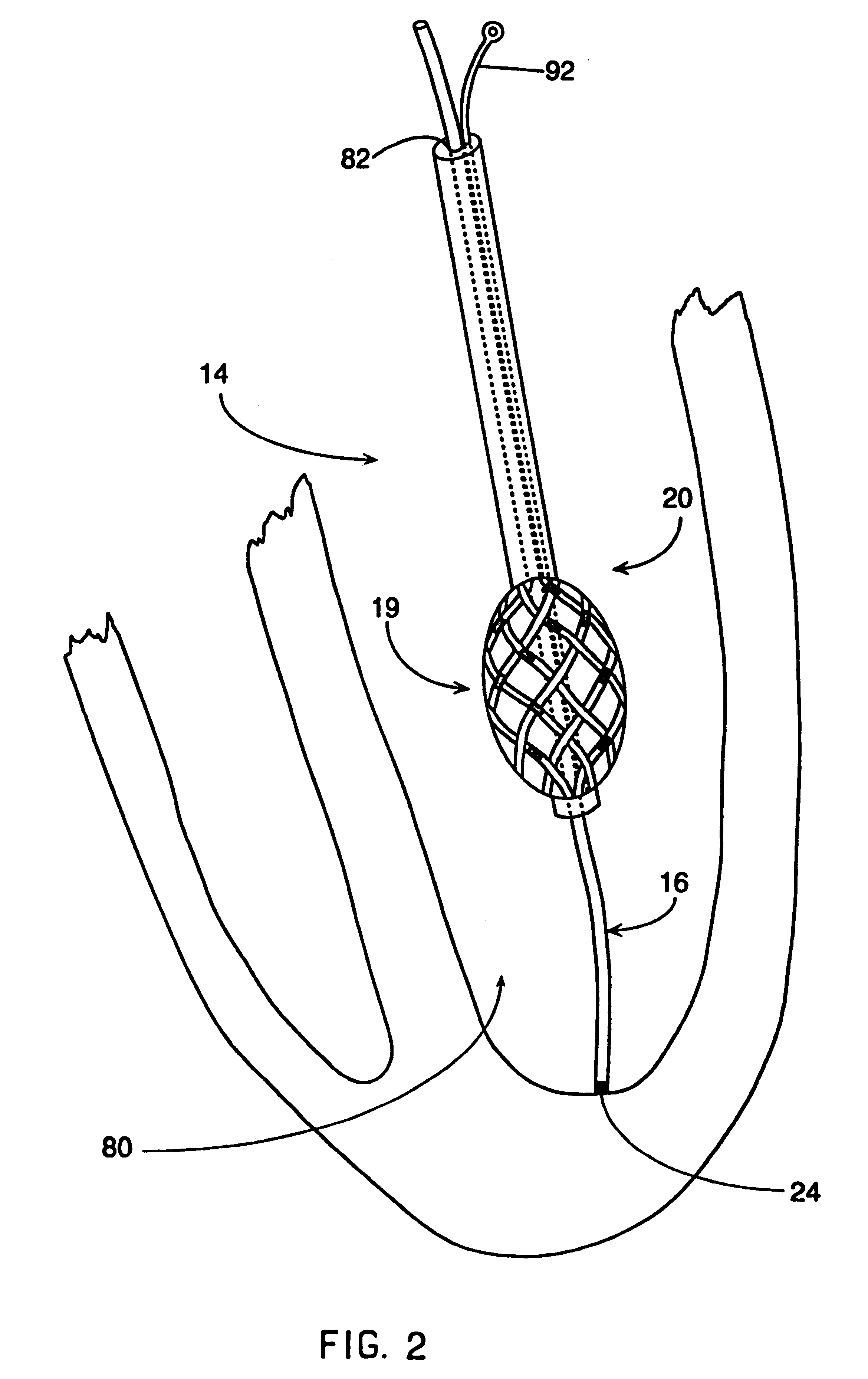 Endocardial mapping system