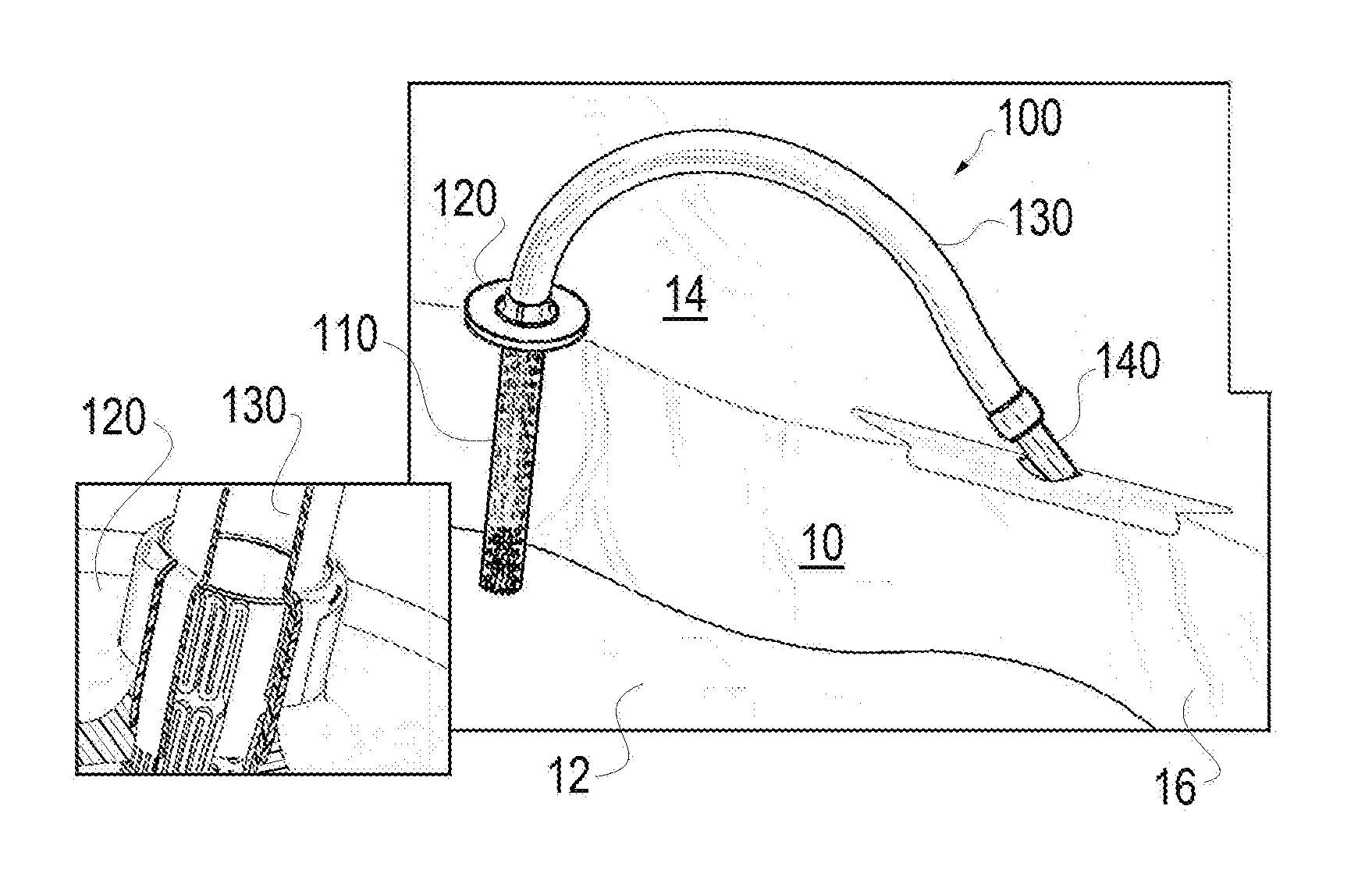 Method and apparatus for coupling left ventricle of the heart to the anterior interventricular vein to stimulate collateral development in ischemic regions