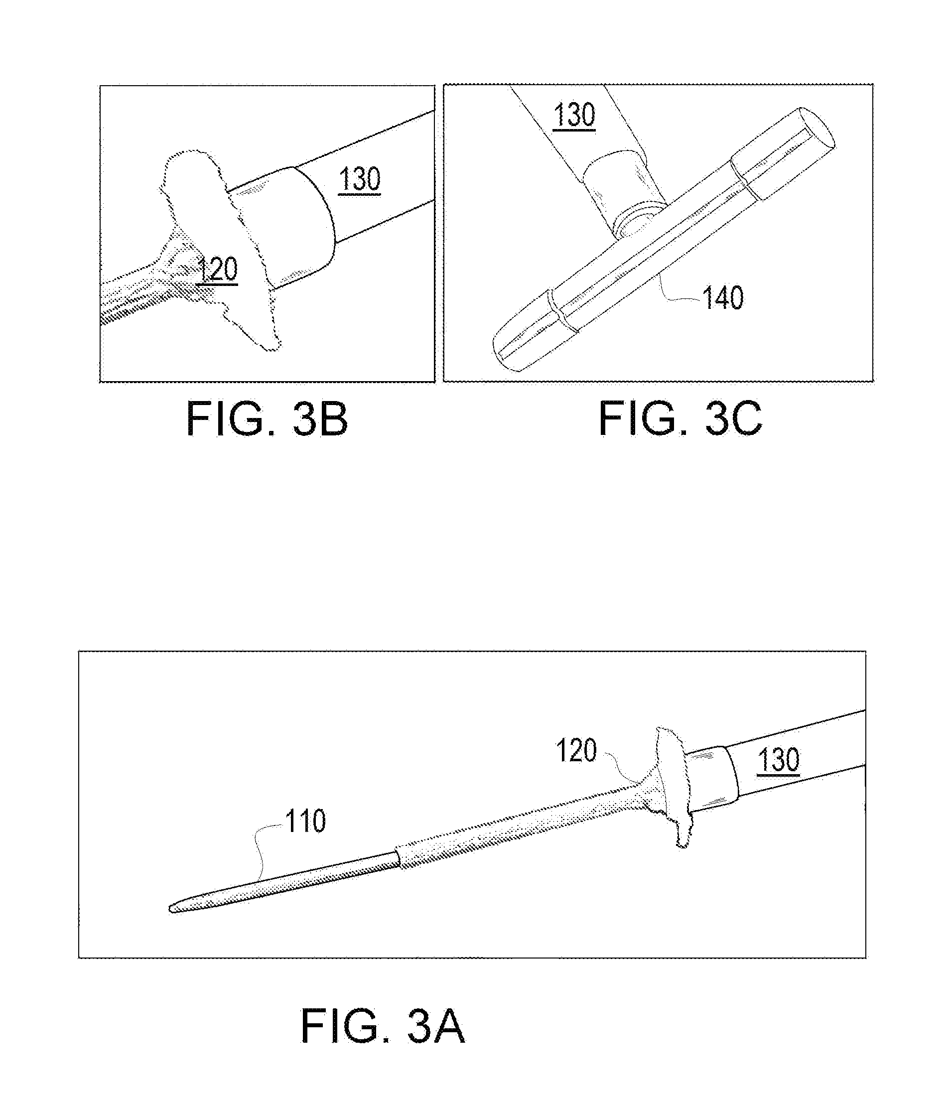 Method and apparatus for coupling left ventricle of the heart to the anterior interventricular vein to stimulate collateral development in ischemic regions