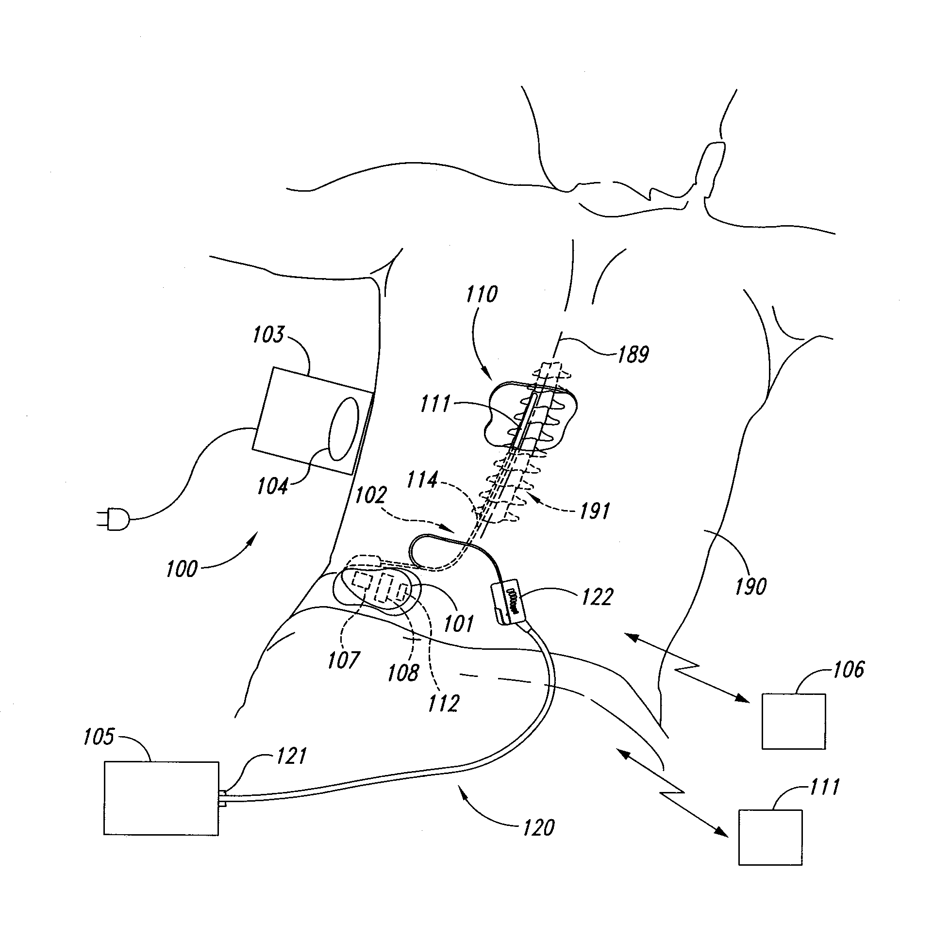 Selective high frequency spinal cord modulation for inhibiting pain with reduced side effects, and associated systems and methods