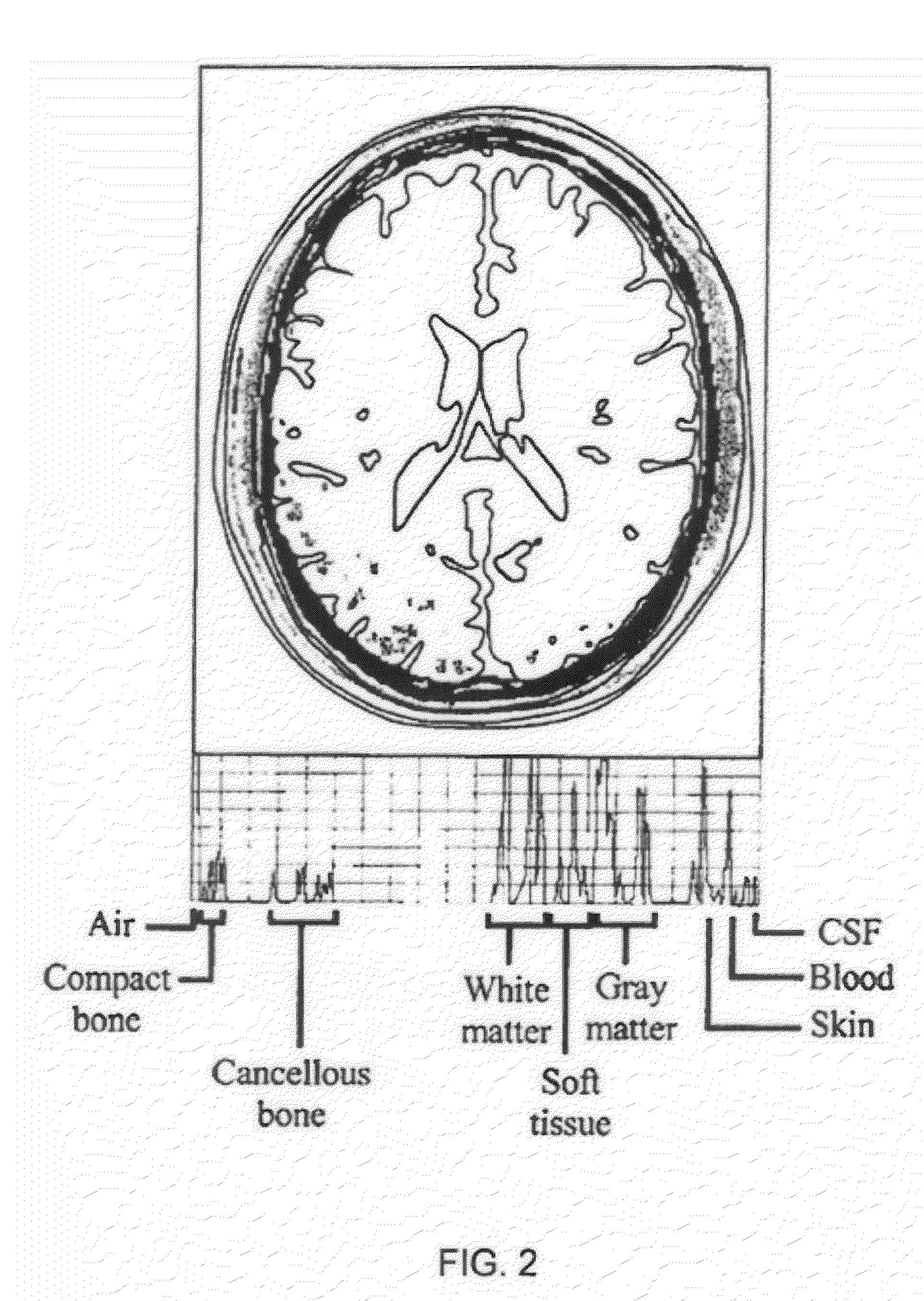 Neurocranial electrostimulation models, systems, devices, and methods