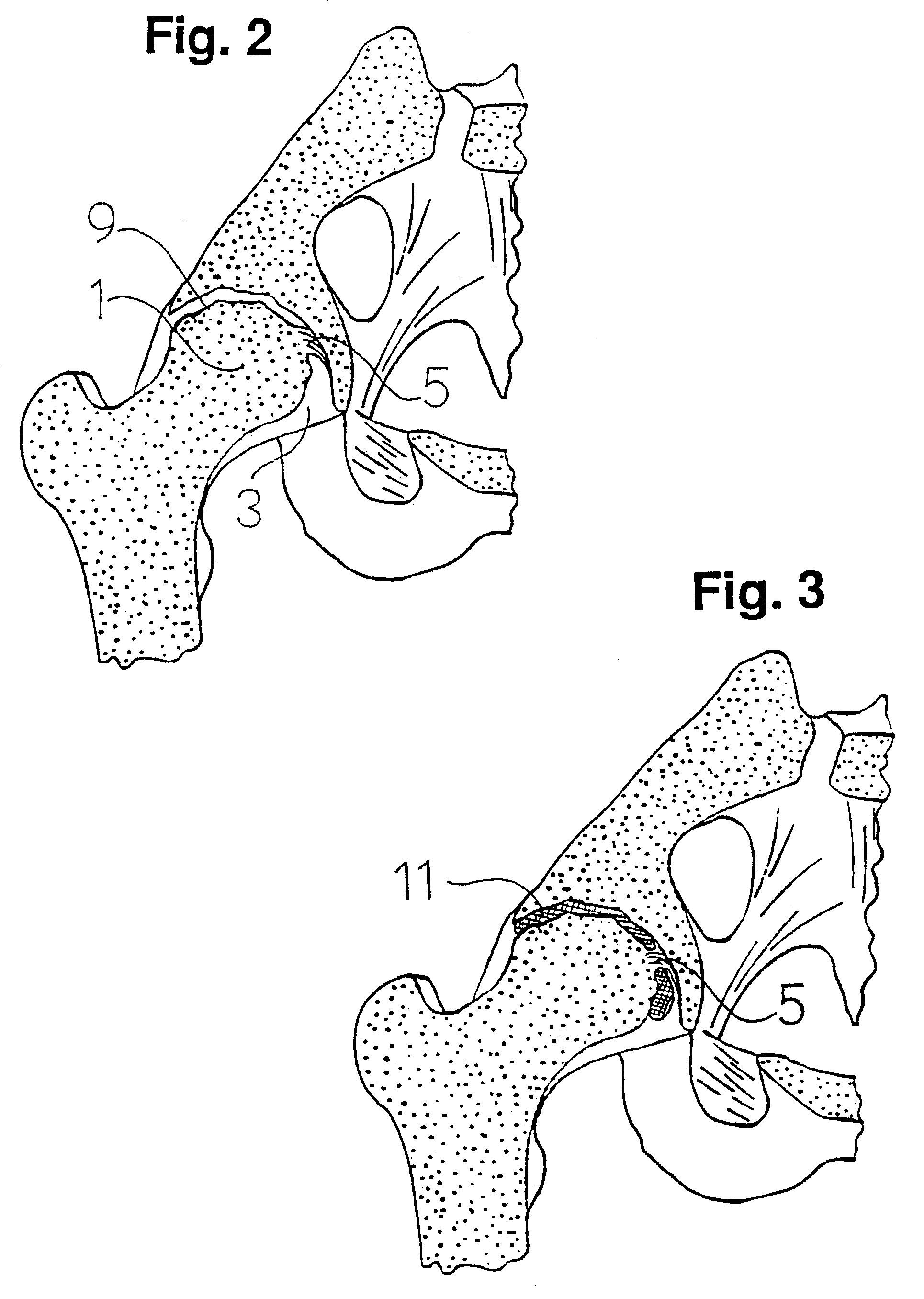 Prosthetic device