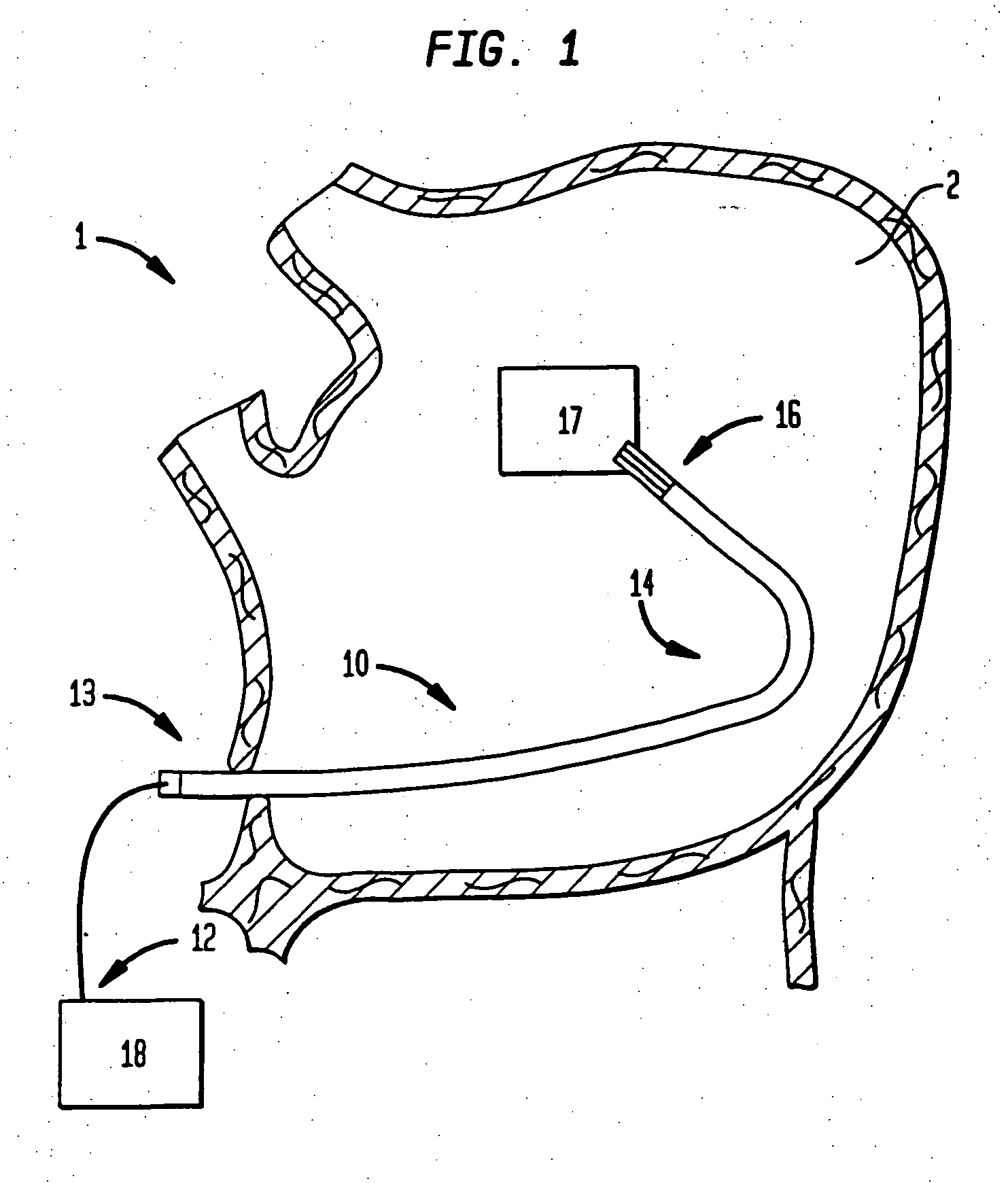 Steerable catheter