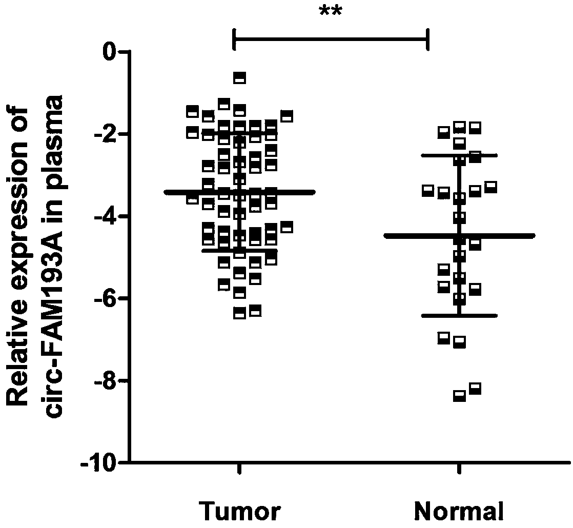 Application of circ-FAM193A molecular marker in blood in diagnosis and prognosis of esophageal squamous carcinoma