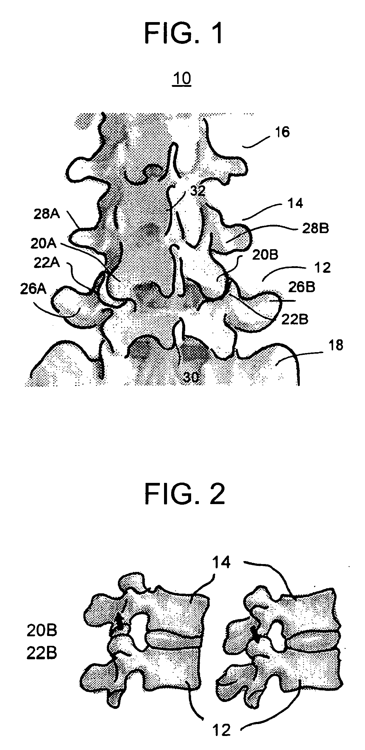 Vertebral facet stabilizer