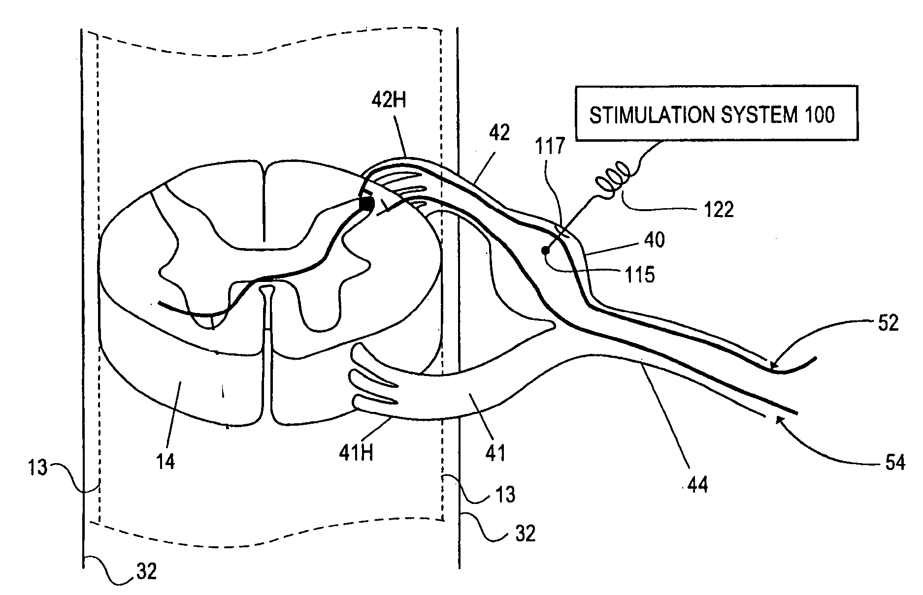 Methods of neurostimulating targeted neural tissue