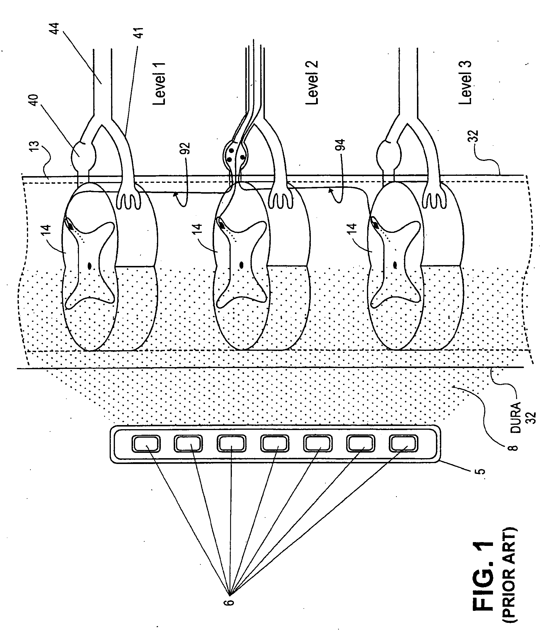 Methods of neurostimulating targeted neural tissue