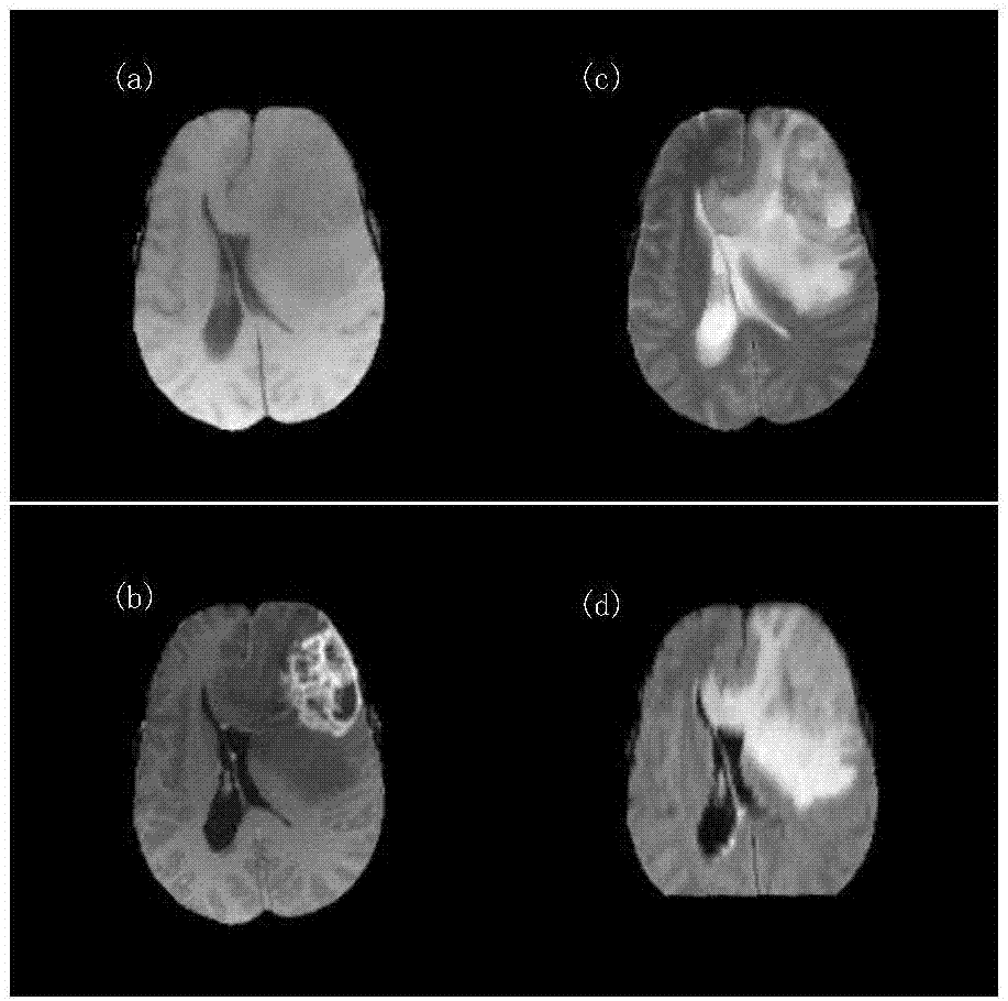 Brain tumor segmentation method and device in combination with convolutional neural network and fuzzy inference