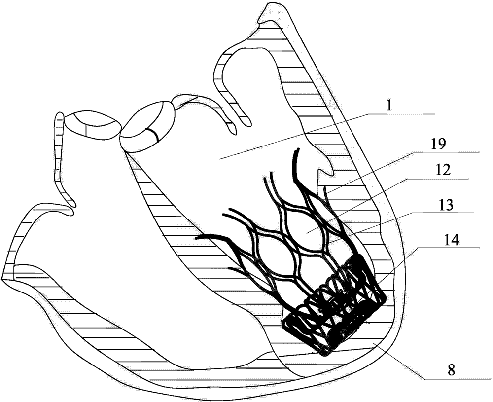 Left ventricle volume reduction device