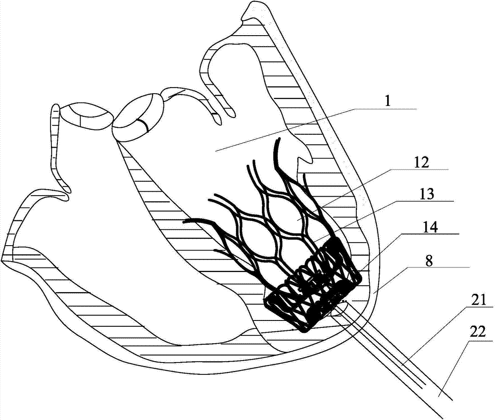 Left ventricle volume reduction device