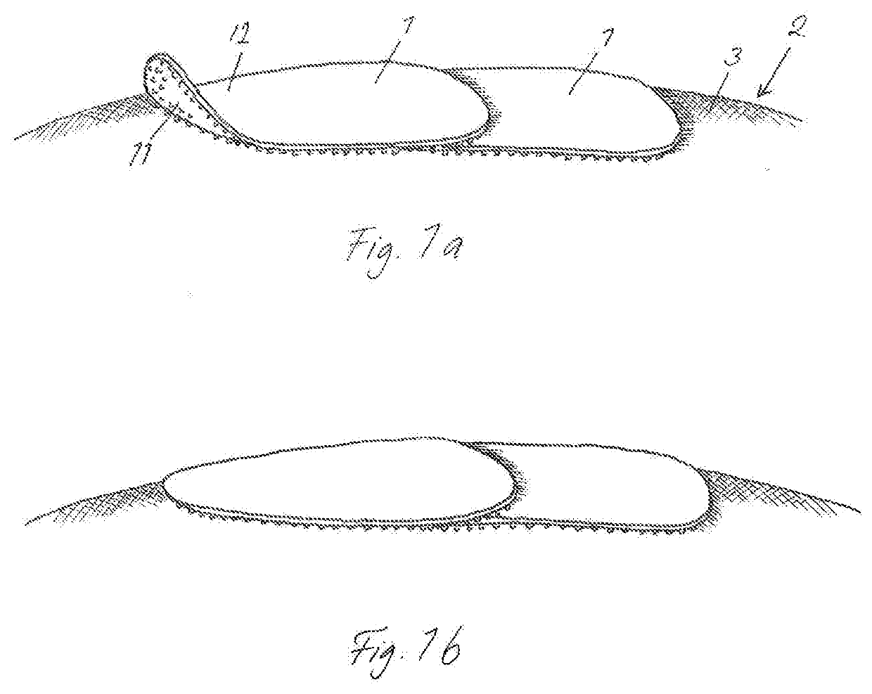 A Kit And Therapeutic Pressure Assembly With Patches For Applying Pressure To A Limb Or Other Body Part