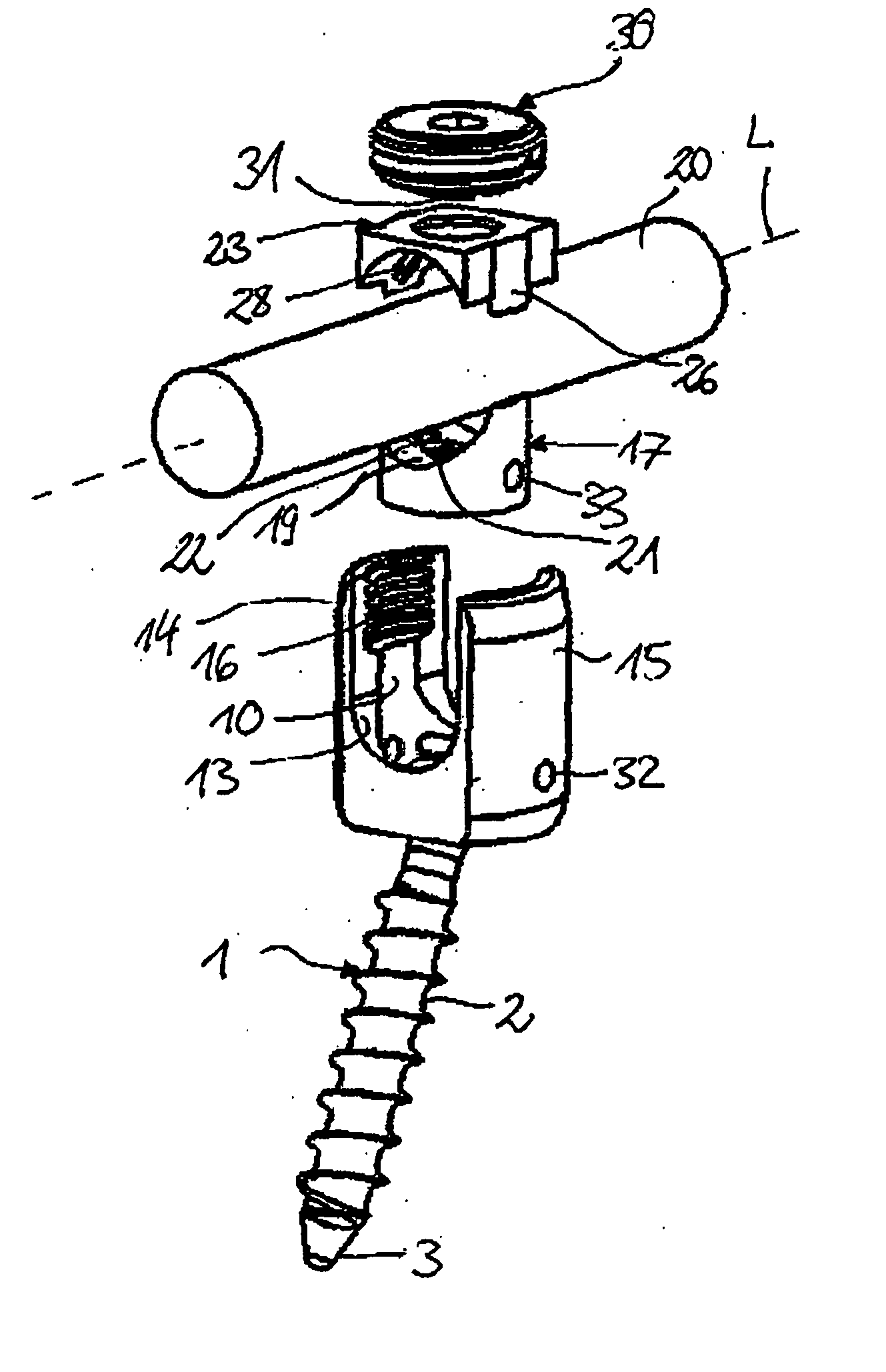 Bone anchoring device