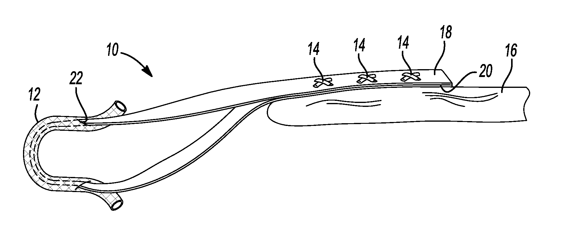 Method And Apparatus For Stitching Tendons