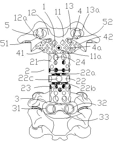 Second cervical vertebra displacer with merging structure