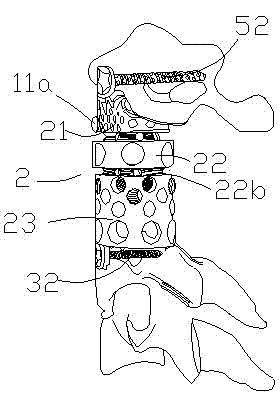 Second cervical vertebra displacer with merging structure