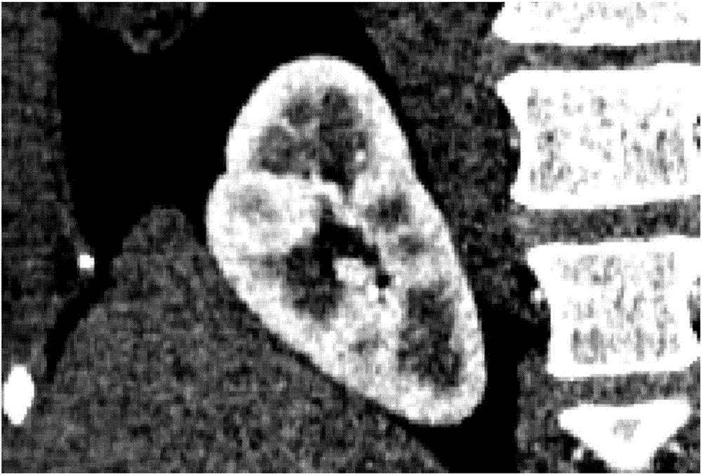 Renal cortex locating method based on statistical shape model