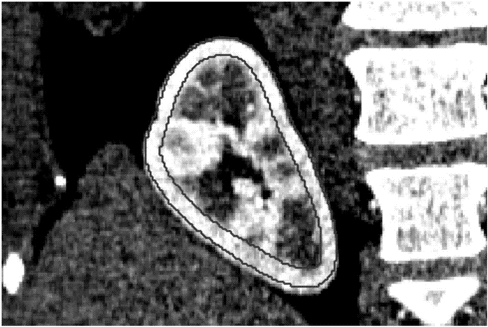 Renal cortex locating method based on statistical shape model