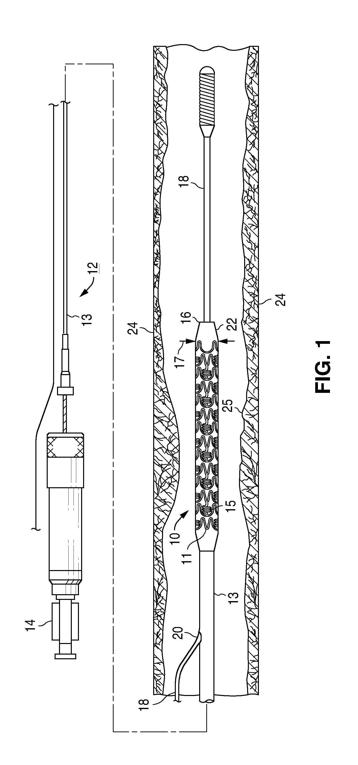 Treatment Of Diabetic Patients With A Drug Eluting Stent And A Drug Coated Balloon