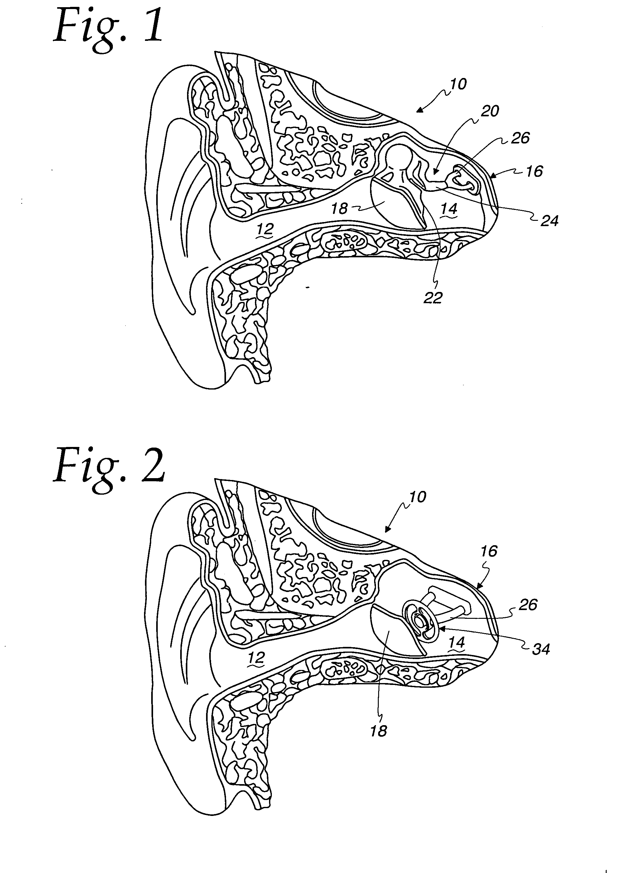 Myringopexy type titanium prosthesis