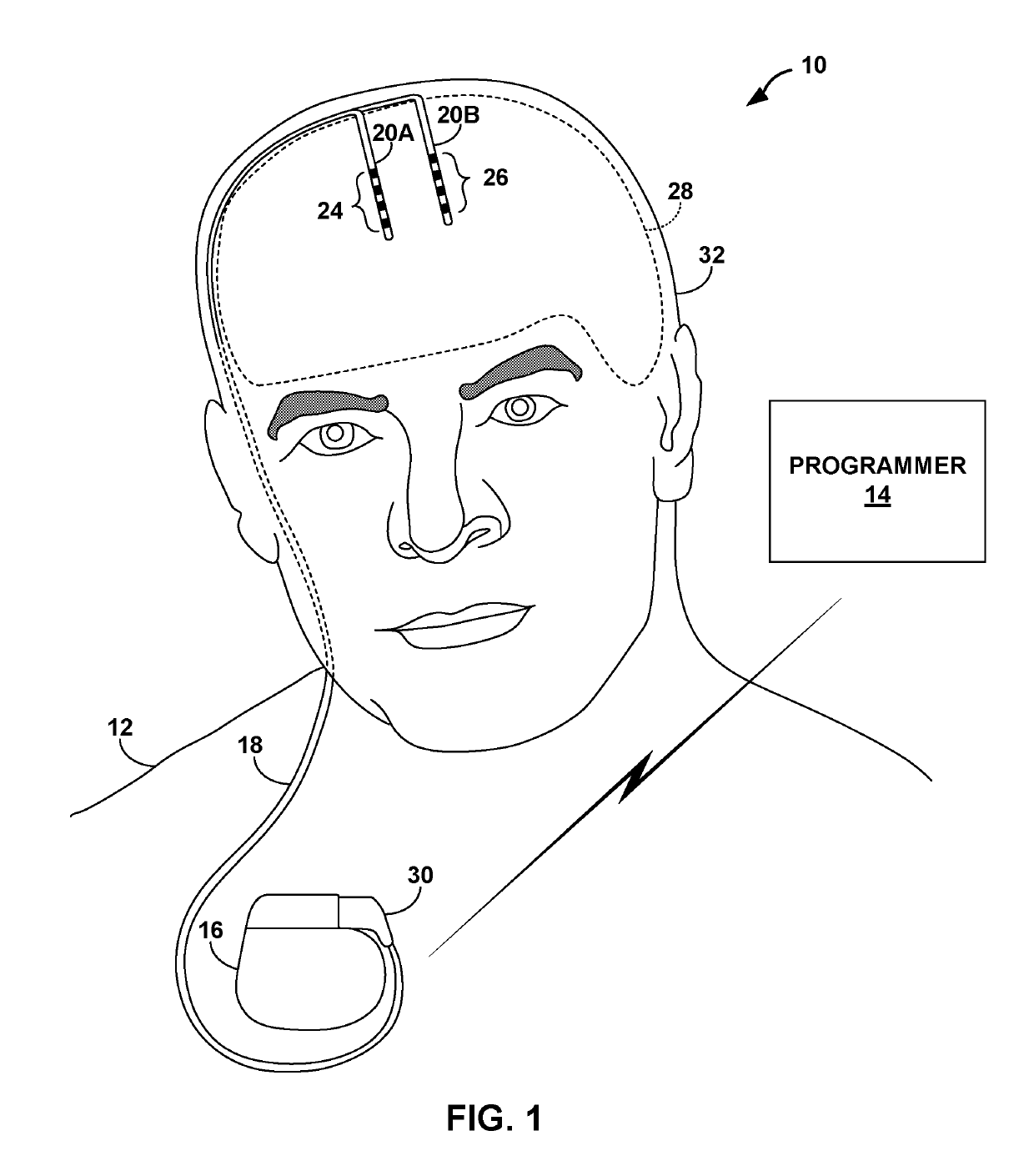 Non-continuous electrical stimulation therapy