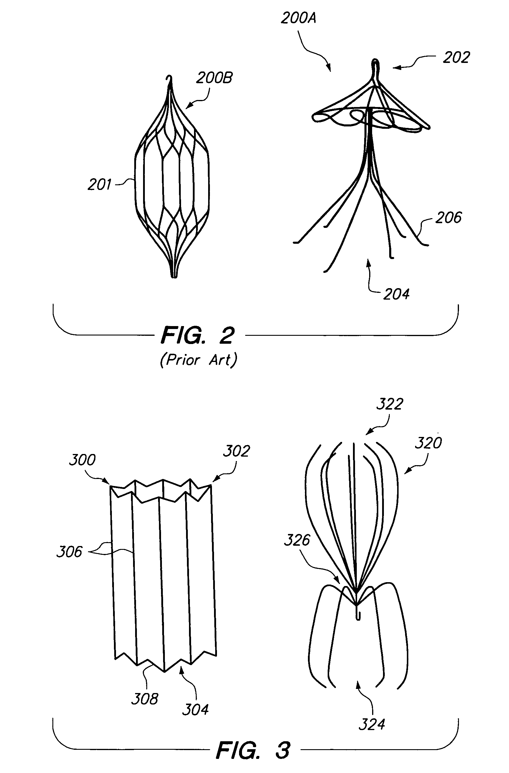 Removable vascular filter and method of filter placement