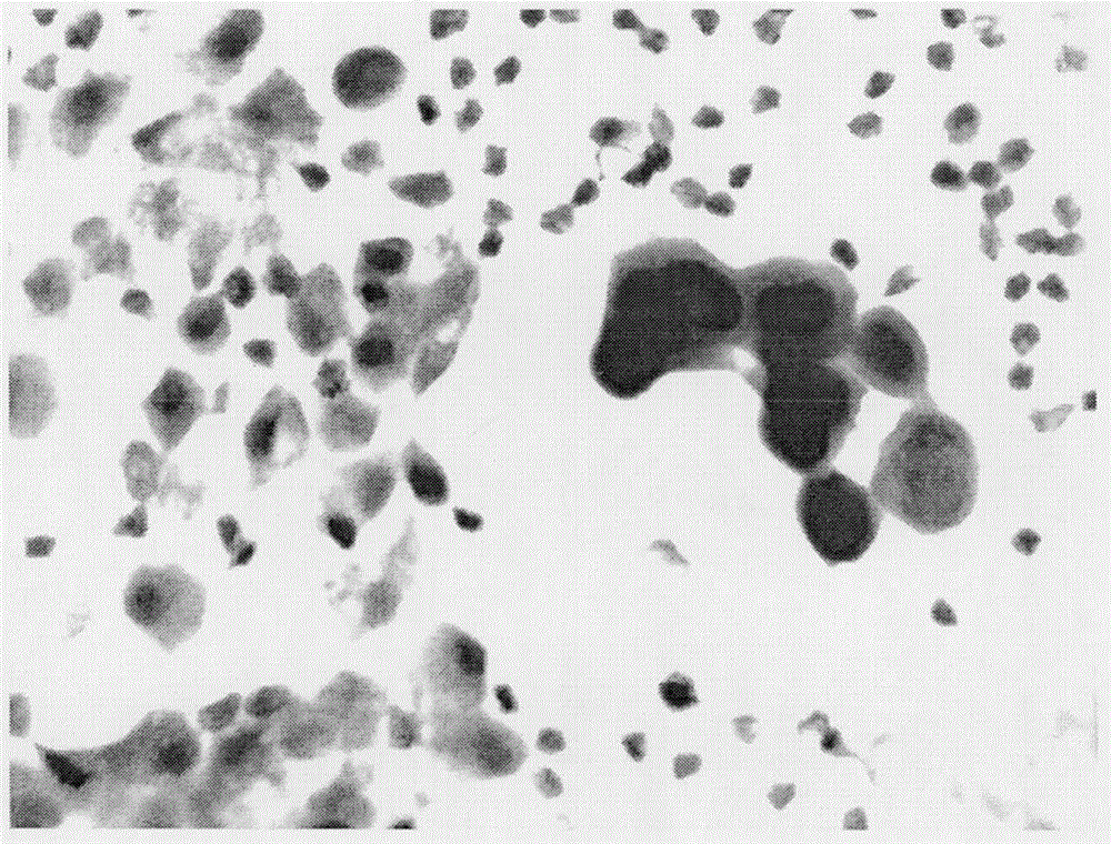 Acid phosphatase staining method for distinguishing malignant serosal cavity effusion mesothelial cells from cancer cells and application thereof