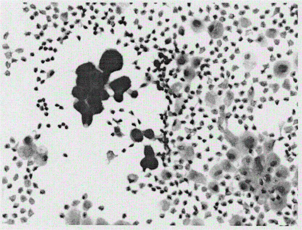 Acid phosphatase staining method for distinguishing malignant serosal cavity effusion mesothelial cells from cancer cells and application thereof