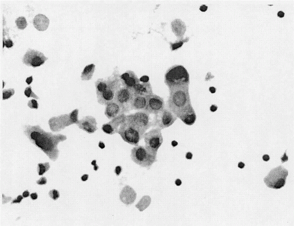 Acid phosphatase staining method for distinguishing malignant serosal cavity effusion mesothelial cells from cancer cells and application thereof